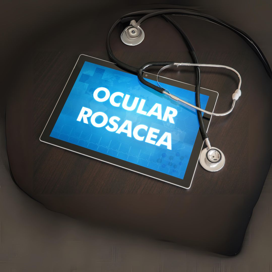 Rosacea Beyond the Skin: Eye Symptoms You Need to Know - Progressive ...